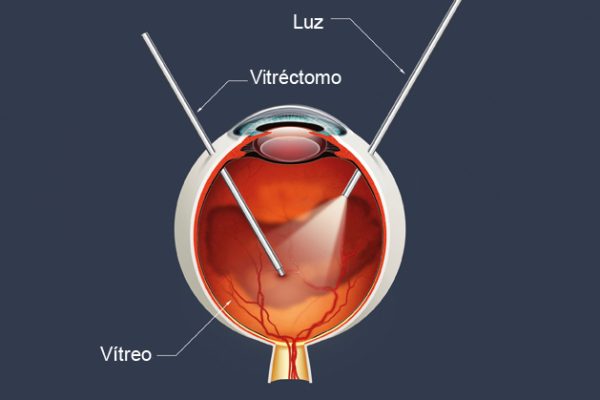 A vitrectomia explicada