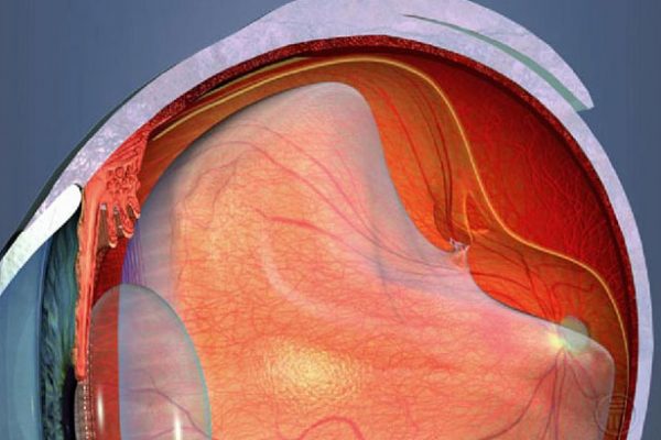 Vítreo para que te quero