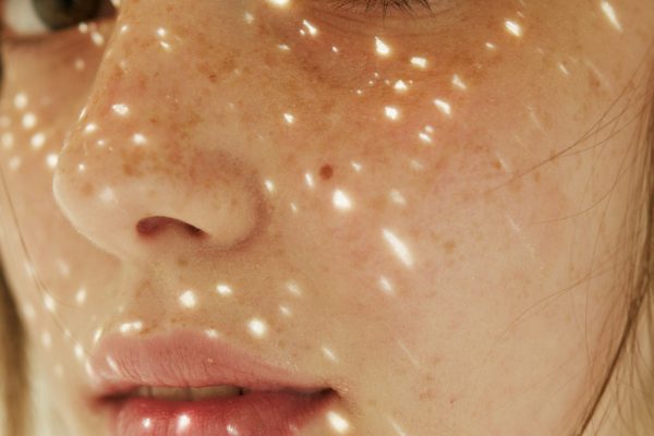 Como eliminar manchas da idade e do sol com foto rejuvenescimento