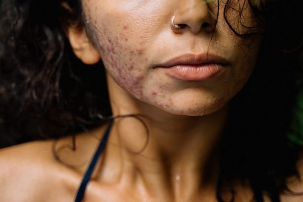 ACNE: O que é, quais as causas e como prevenir?