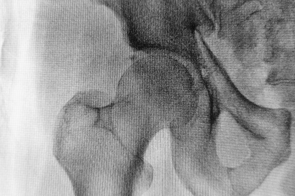 Conflito femoro acetabular: Saiba o que é, conheça as causas e os tratamentos.